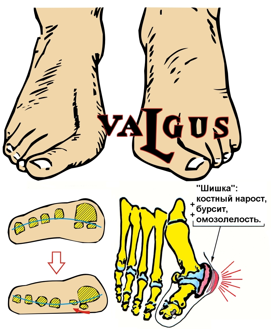 “Косточки” на ногах (hallux valgus)